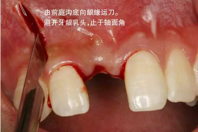 口腔种植手术学图解 组织切开与翻瓣(图13)